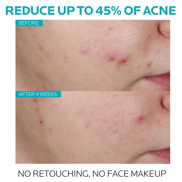 Acne Treatment Salicylic Acid Face Serum