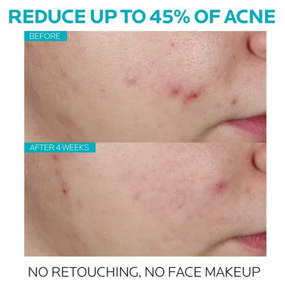 Acne Treatment Salicylic Acid Face Serum