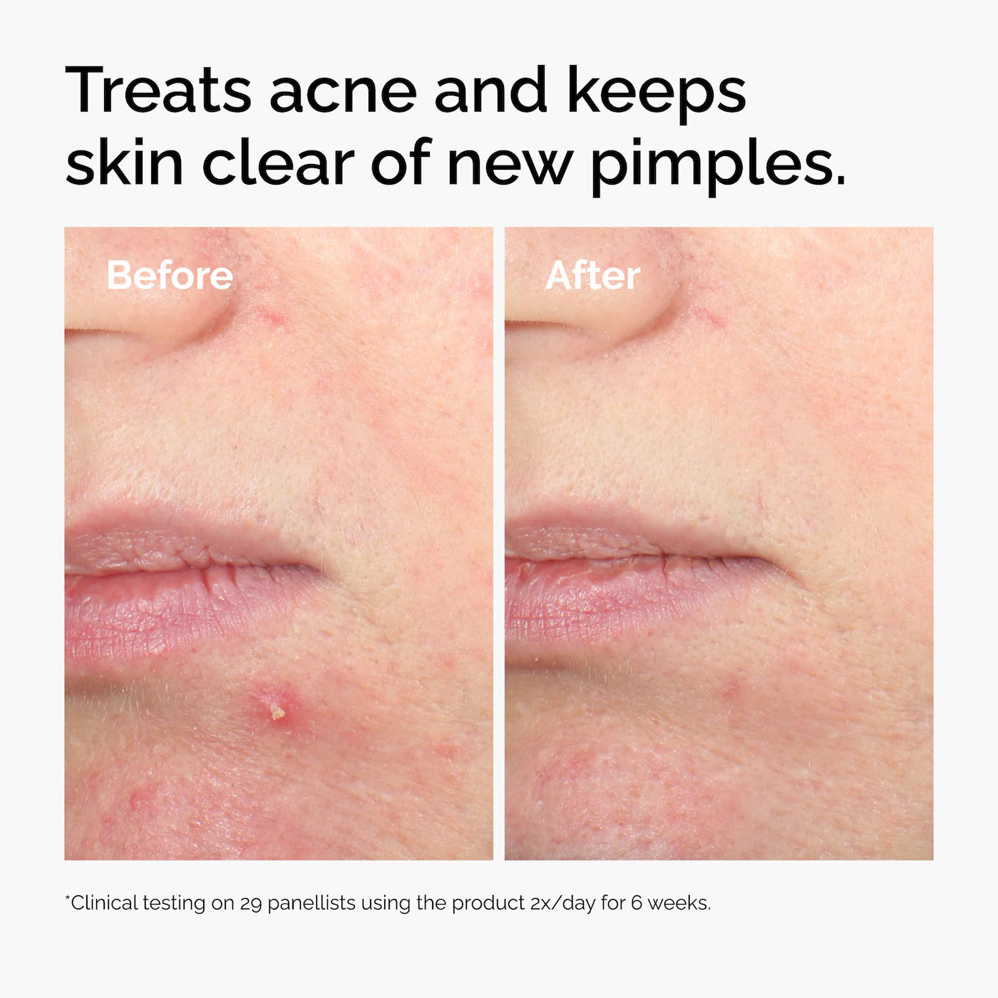 Salicylic Acid 2% Solution 30ml